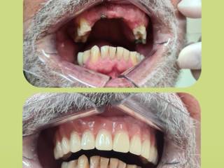 Venha conferir esse Antes e Depois de Prótese Dentária em Bauru