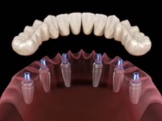 Implantes dentais osseointegráveis para pacientes que usam próteses totais ou que necessitam extrações de todos os dentes remanescentes 