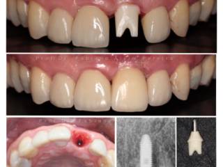 Implantes dentais, o melhor tratamento para reposição de  um ou múltiplos dentes perdidos (raízes dentárias artificiais)