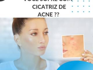 Você sofre com cicatriz de Acne?