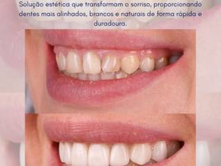 Facetas de porcelana