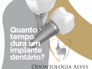 Quanto Tempo Dura um Implante Dentário?