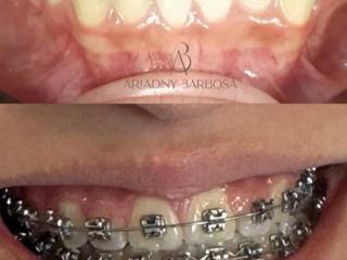 Tratamento com aparelhos ortodônticos na Evidence Odontologia e Estética em Mineiros