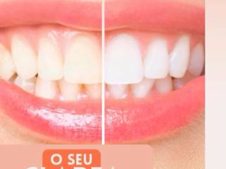 Clareamento Dental em Mineiros para um sorriso mais branco e saudável