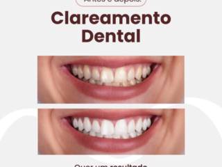 Seu sorriso ainda mais belo! Conheça o Clareamento Dental de Evidence em Mineiros 