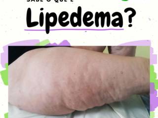 Você sabe o que é Lipedema?