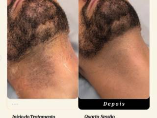 Barba no laser: mais praticidade para o seu dia a dia