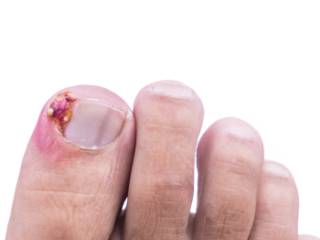 O que piora a uma encravada