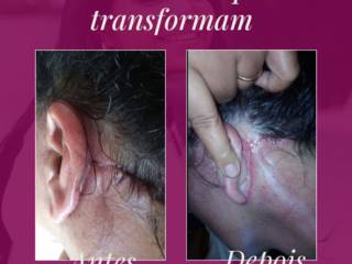 Cuidados Essenciais no Pós-Operatório Lifting Facial