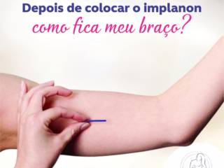 Como fica o braço após a colocação do implanon