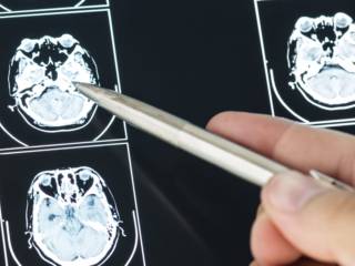 5 sinais de que é hora de visitar um Neurologista