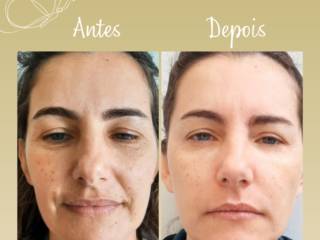 Quais são os benefícios do Botox?