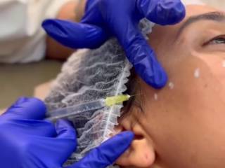 Quais os benefícios do botox para o rosto?