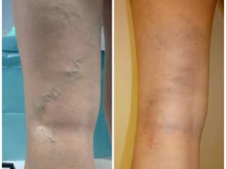 Tratamento de varizes: Mudança na qualidade de vida!