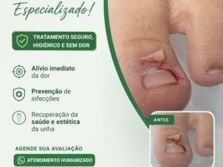 Unha Encravada? Cuide Antes que a Dor Piore