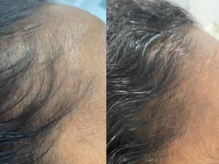 Antes e depois do tratamento de crescimento capilar