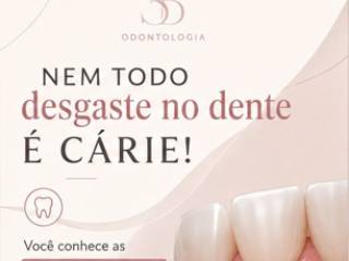 Nem Todo Desgaste nos Dentes é Cárie!!