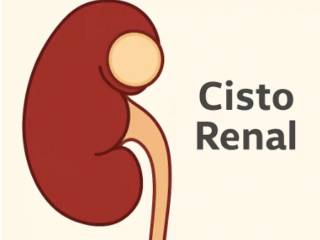 Cistos Renais: Classificação, Diagnóstico e Quando se Preocupar