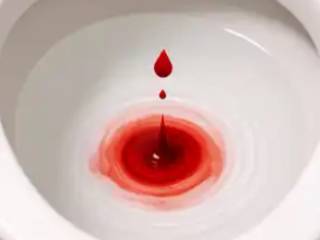 Hematúria: quando o sangue na urina é sinal de alerta?