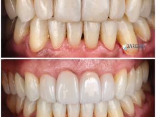 Laminados cerâmicos: a arte de valorizar seu sorriso natural