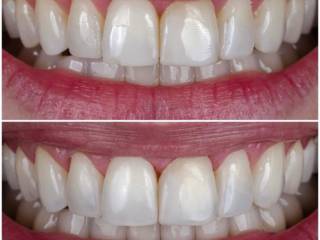 Profilaxia Master AirFlow: Limpeza Profunda e Renovação para o Seu Sorriso