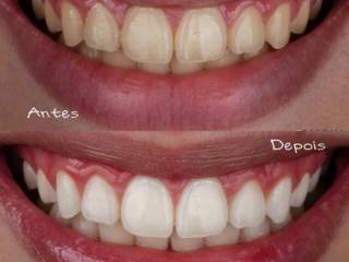 Seu novo sorriso começa com um clareamento dental