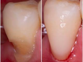 Restauração cervical: mais proteção, conforto e estética para o seu sorriso