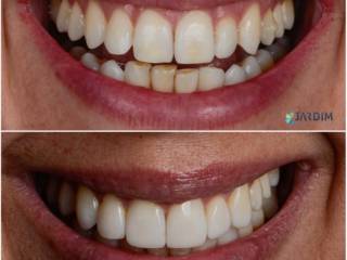 Ortodontia e facetas em resina: um sorriso planejado em cada etapa