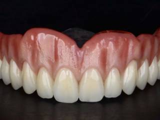 Prótese Total Personalizada para um Sorriso Natural