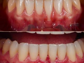 Enxerto Gengival para um Sorriso Mais Harmônico
