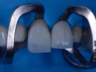 Lentes de porcelana com preservação e naturalidade