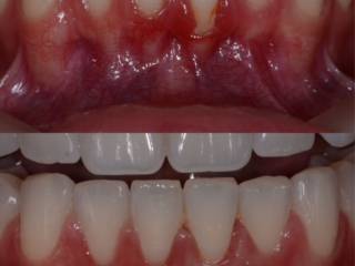 Enxerto gengival: proteção, saúde e harmonia para o sorriso