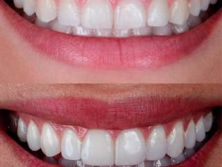 Facetas que valorizam a beleza natural do sorriso
