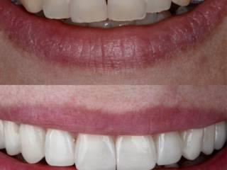 Ortodontia e facetas para um sorriso mais harmônico