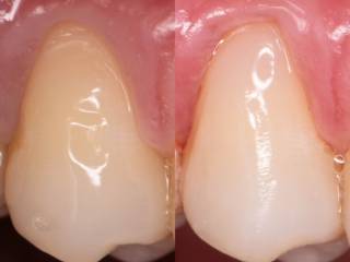 Pequenos detalhes podem transformar o sorriso