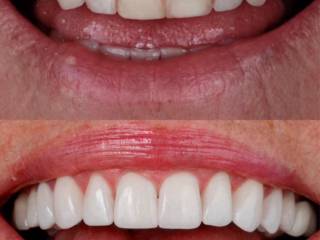 Transformação do sorriso com facetas em porcelana