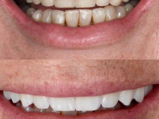 Reabilitação do sorriso com prótese total