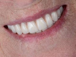 Um novo sorriso pode transformar não apenas a aparência, mas também o conforto e a qualidade de vida