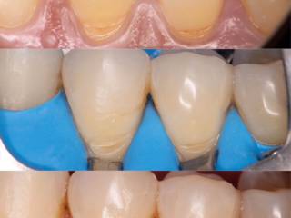 Restaurações dentárias em Francisco Beltrão