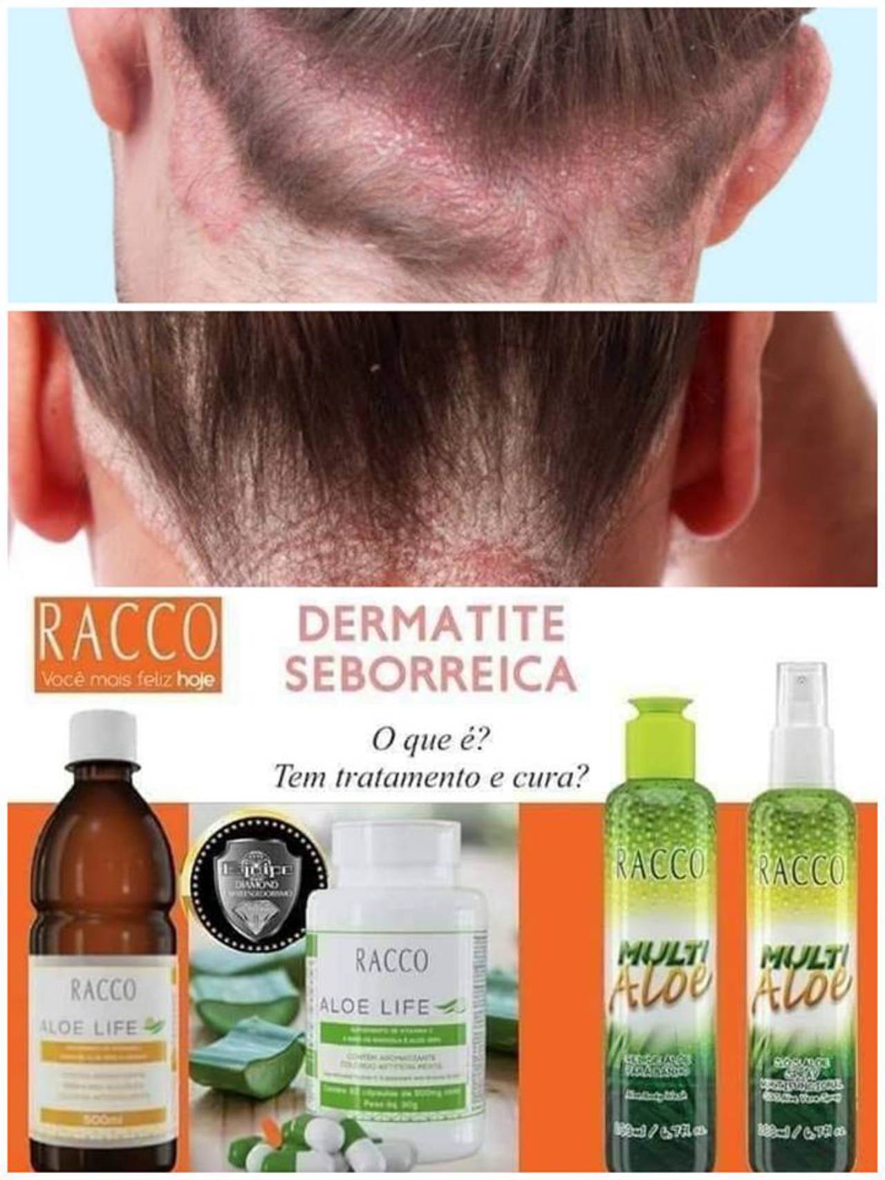 Tratamento Dermatite Seborreica Em Bauru, SP | Classificados - Solutudo