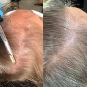Tratamento para Alopecia