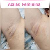 Depilação Axilias Femininas 
