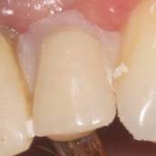 Dente Provisorio (dente de estoque) 