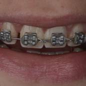 A ortodontia convencional é um tratamento altamente eficaz para correção de maloclusões e alinhamento dentário, utilizando aparelhos fixos com bráquetes e fios metálicos ou estéticos. Cada componente é planejado de forma precisa para exercer forças controladas, permitindo movimentações dentárias graduais e previsíveis. Tudo isso a fim de ter uma correção da função e estética.
A ortodontia combina precisão biomecânica e planejamento clínico detalhado, promovendo não apenas um sorriso mais bonito, mas também dentes e gengivas mais saudáveis. 