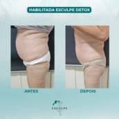 Massagem Método Esculpe Detox em Avaré – Corpo Leve e Remodelado
