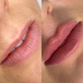 Preenchimento labial