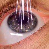 cirurgia refrativa - Personalizada a laser