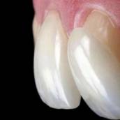 Lentes Dentais de Porcelana em Resende, RJ por Clínica Torquato