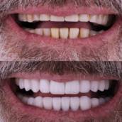 Facetas em Resina Composta