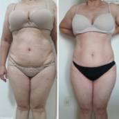 Tratamento para Gordura Localizada em Avaré – Corpo Definido e Firme
